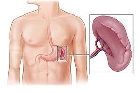 Παθολογία της σπλήνας ως αιτία πόνου κάτω από την αριστερή ωμοπλάτη