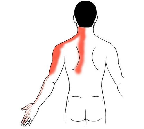 αυχενική οστεοχονδρωσία ως αιτία πόνου στις αρθρώσεις των δακτύλων